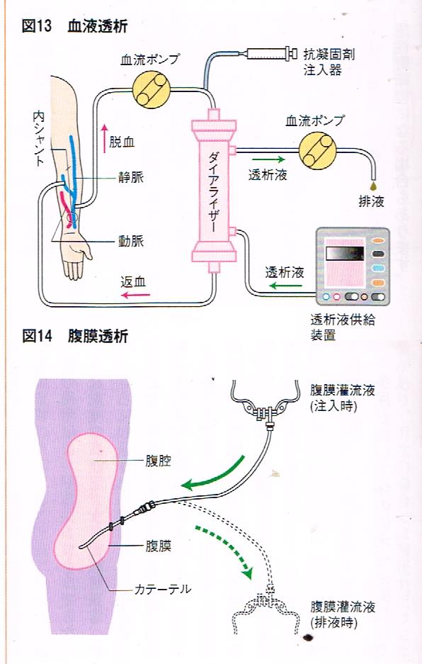 血液透析と腹膜透析