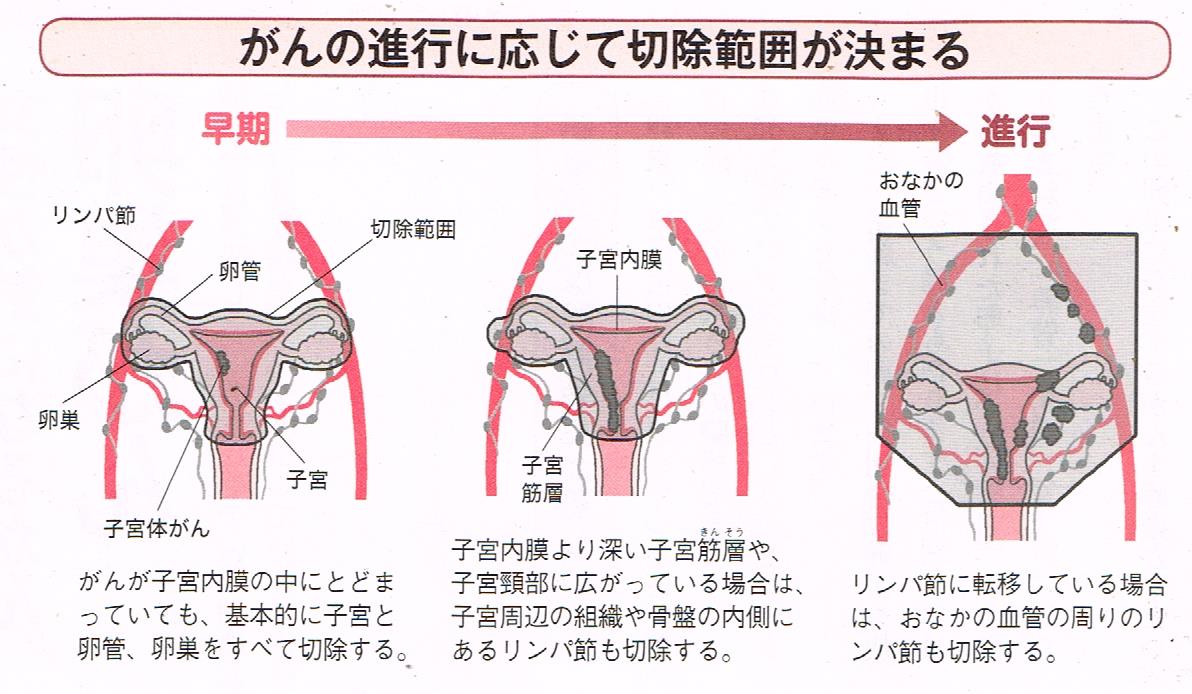 癌の進行に応じて切除範囲が決まる