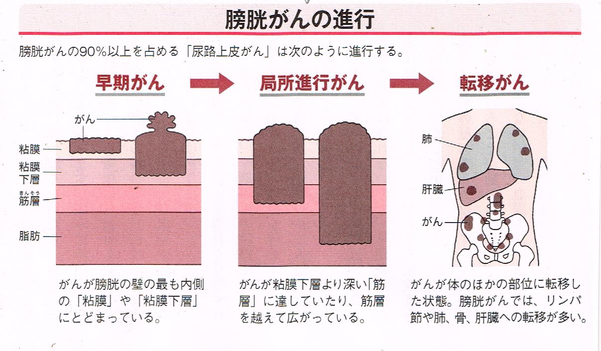 膀胱癌の進行