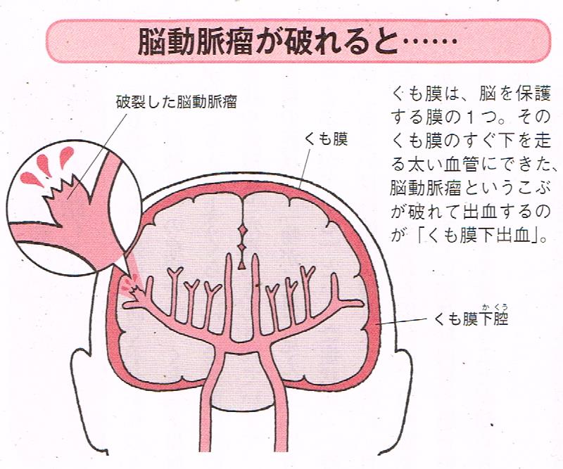 くも膜下出血の原因