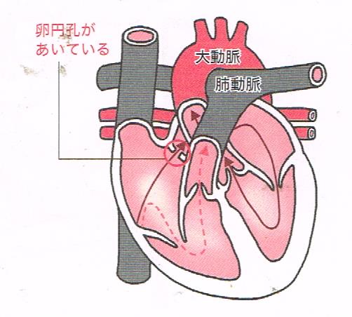 脳梗塞に関係する心臓の異変②卵円孔があいている