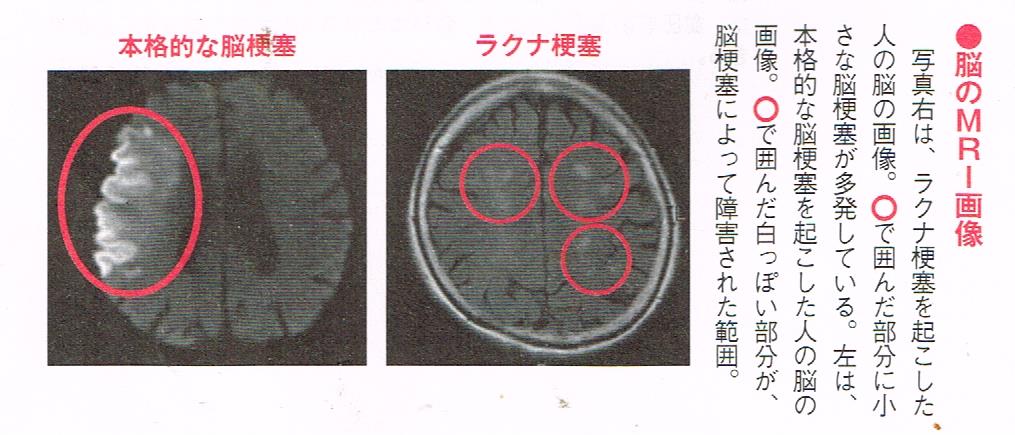 心房細動の原因