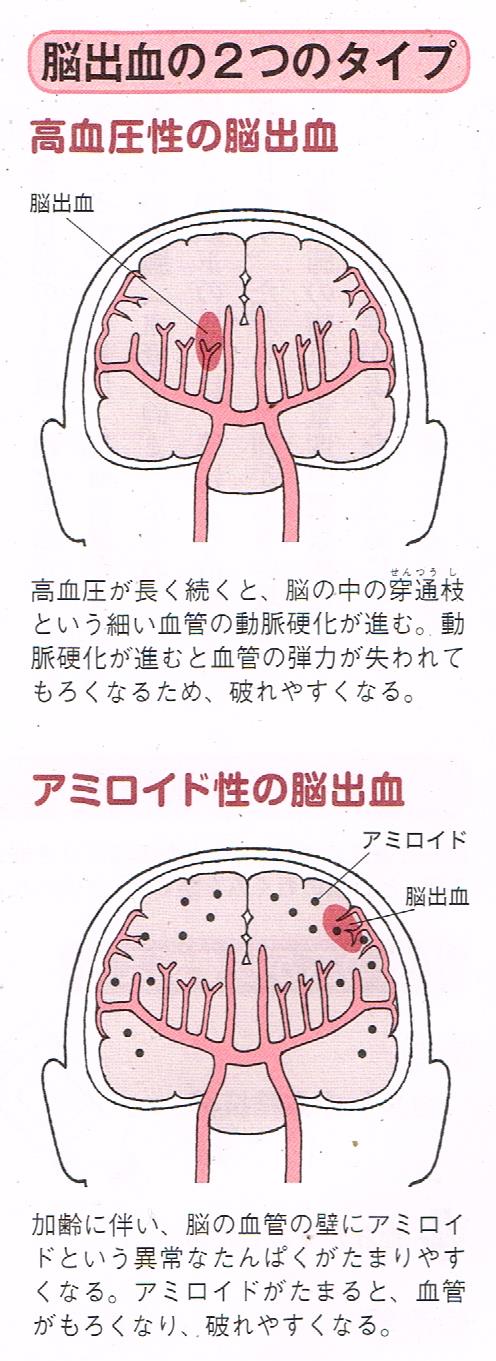 脳出血の２つのタイプ