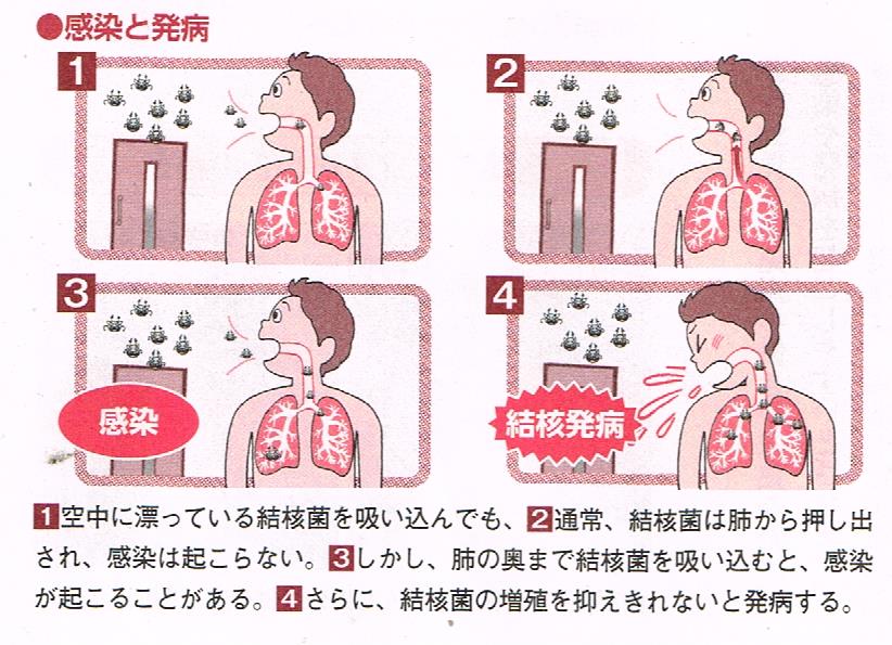 感染から発病へ