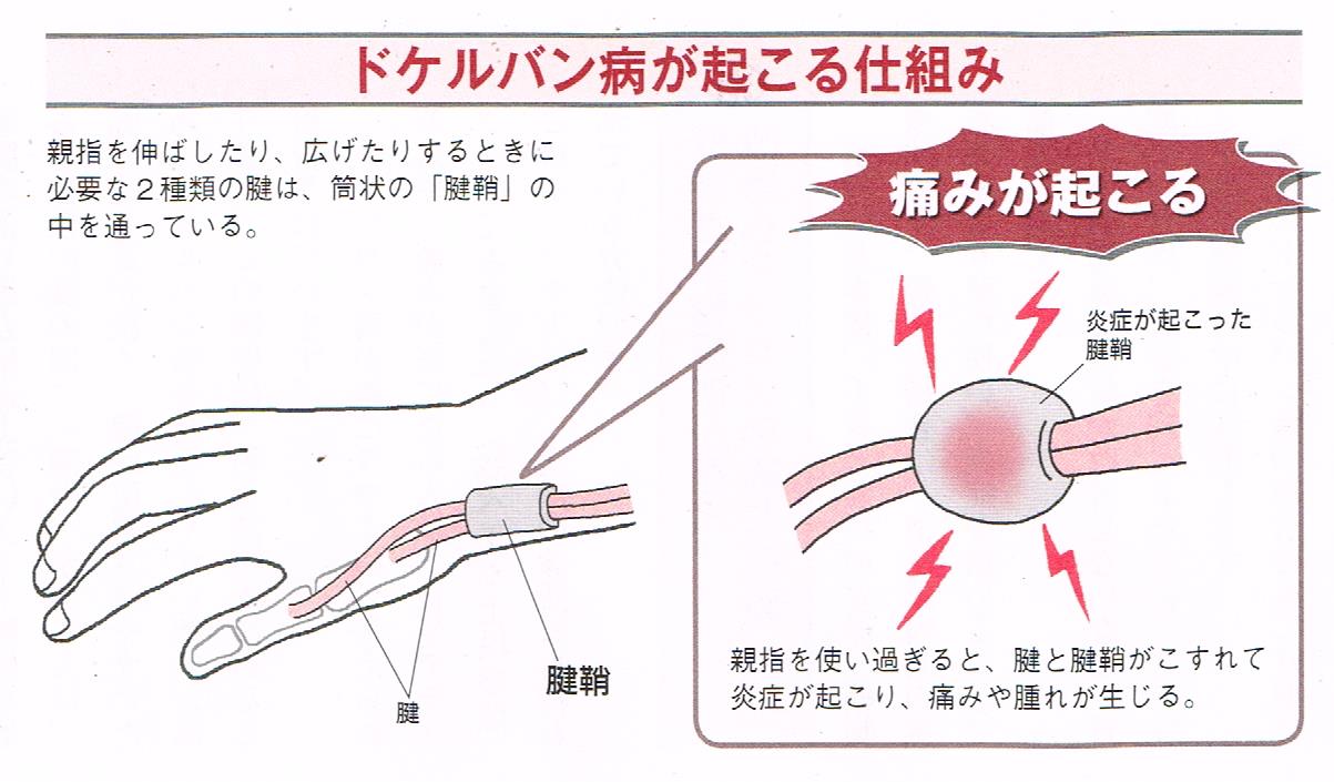 ドケルバン病が起こる仕組み