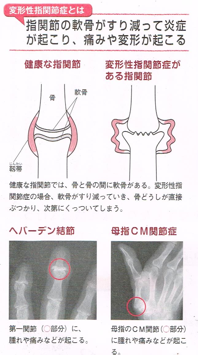 変形性指関節症