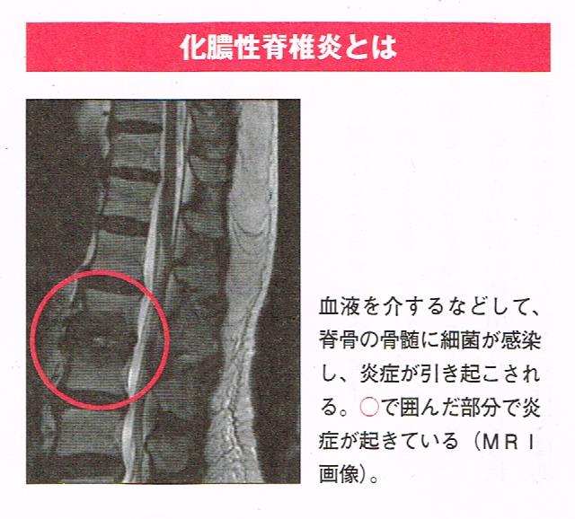 化膿性脊椎炎