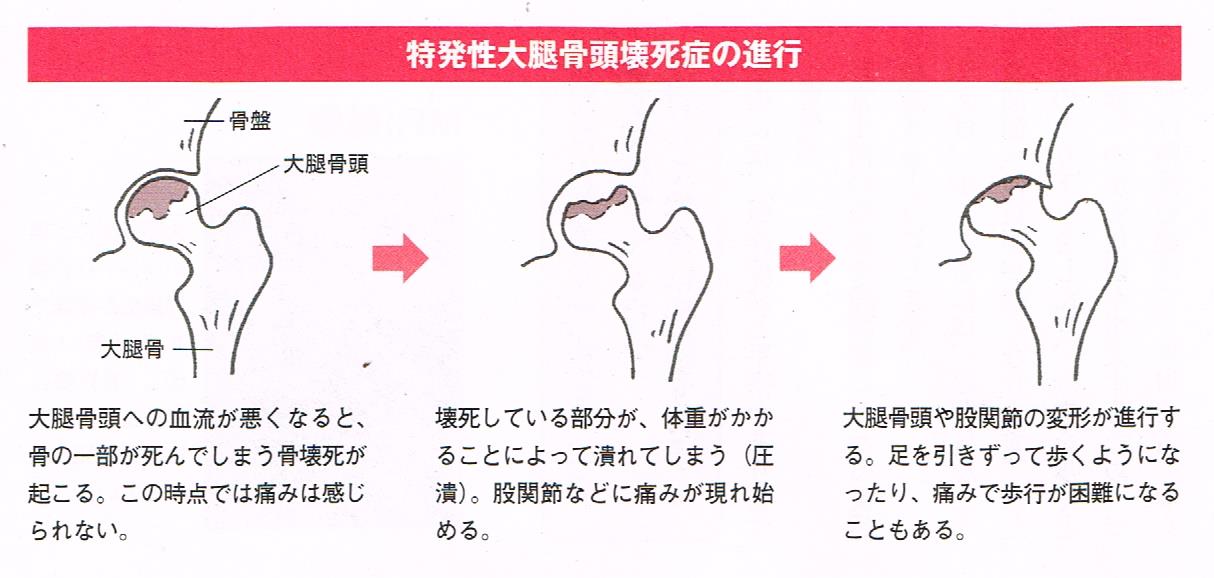 特発性大腿骨頭壊死症の進行