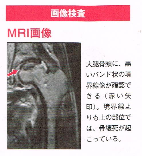 特発性大腿骨頭壊死症の画像検査