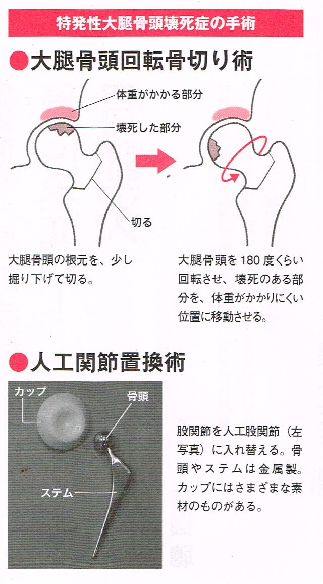 特発性大腿骨頭壊死症の手術