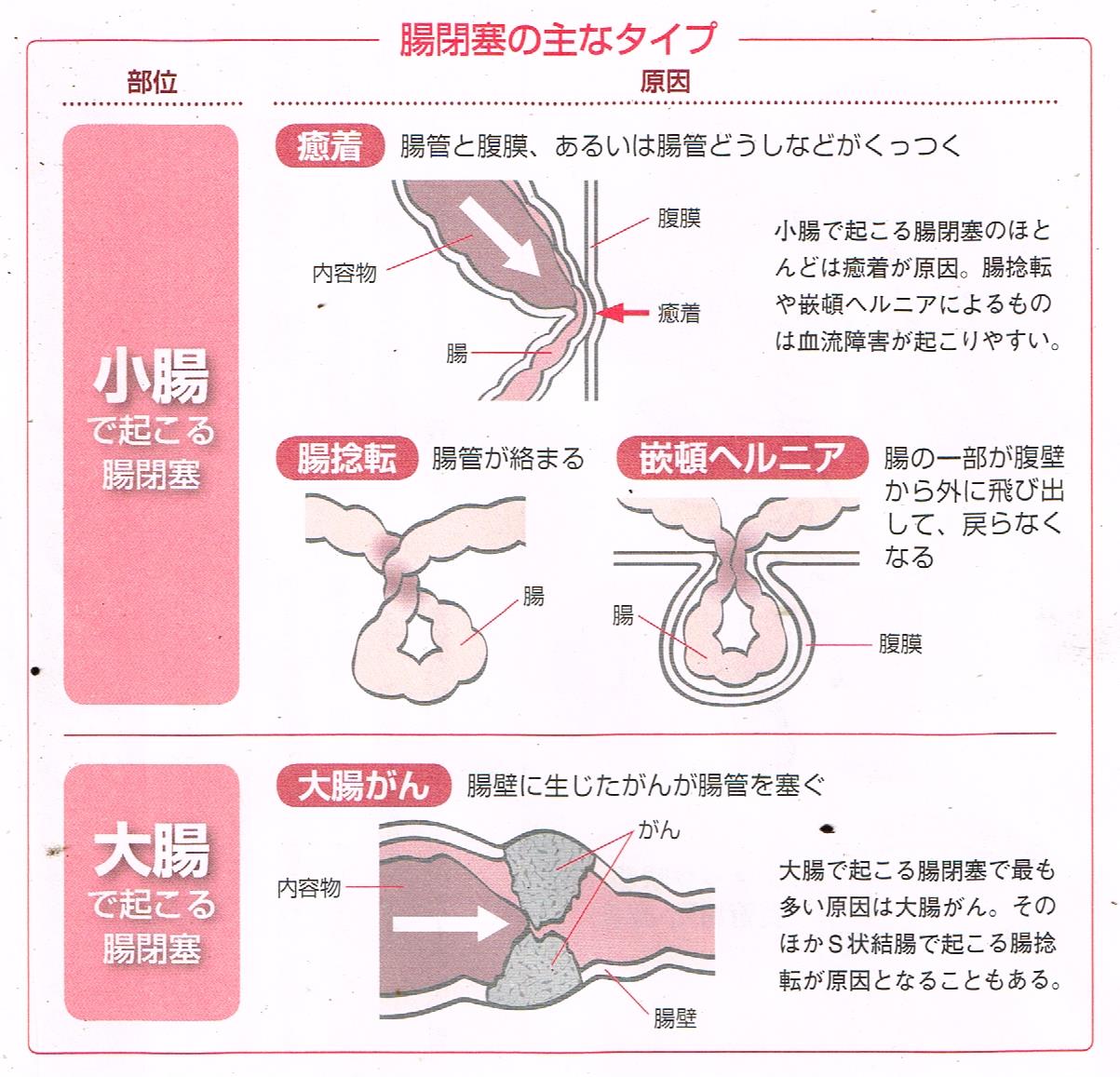 腸閉塞の主なタイプ