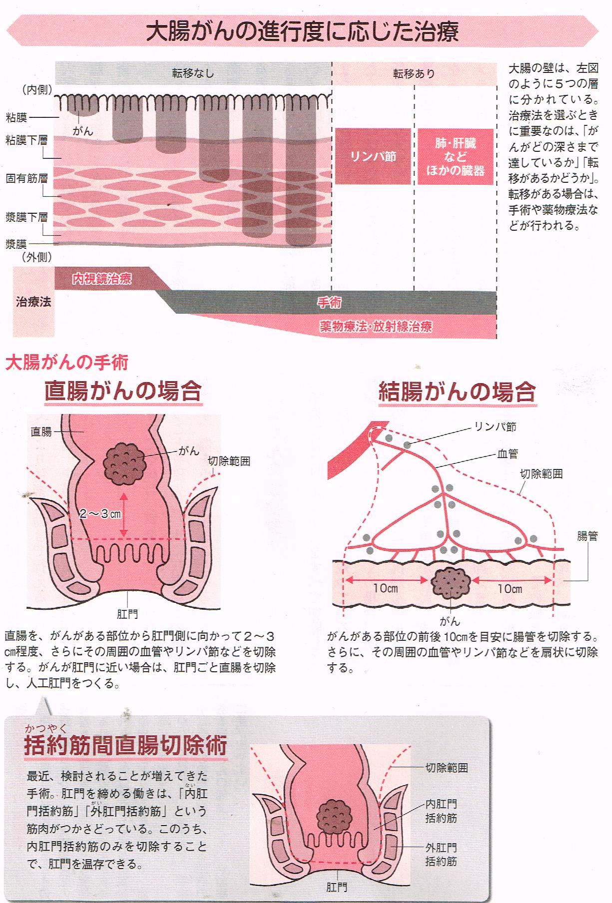 大腸癌の進行度に応じた治療