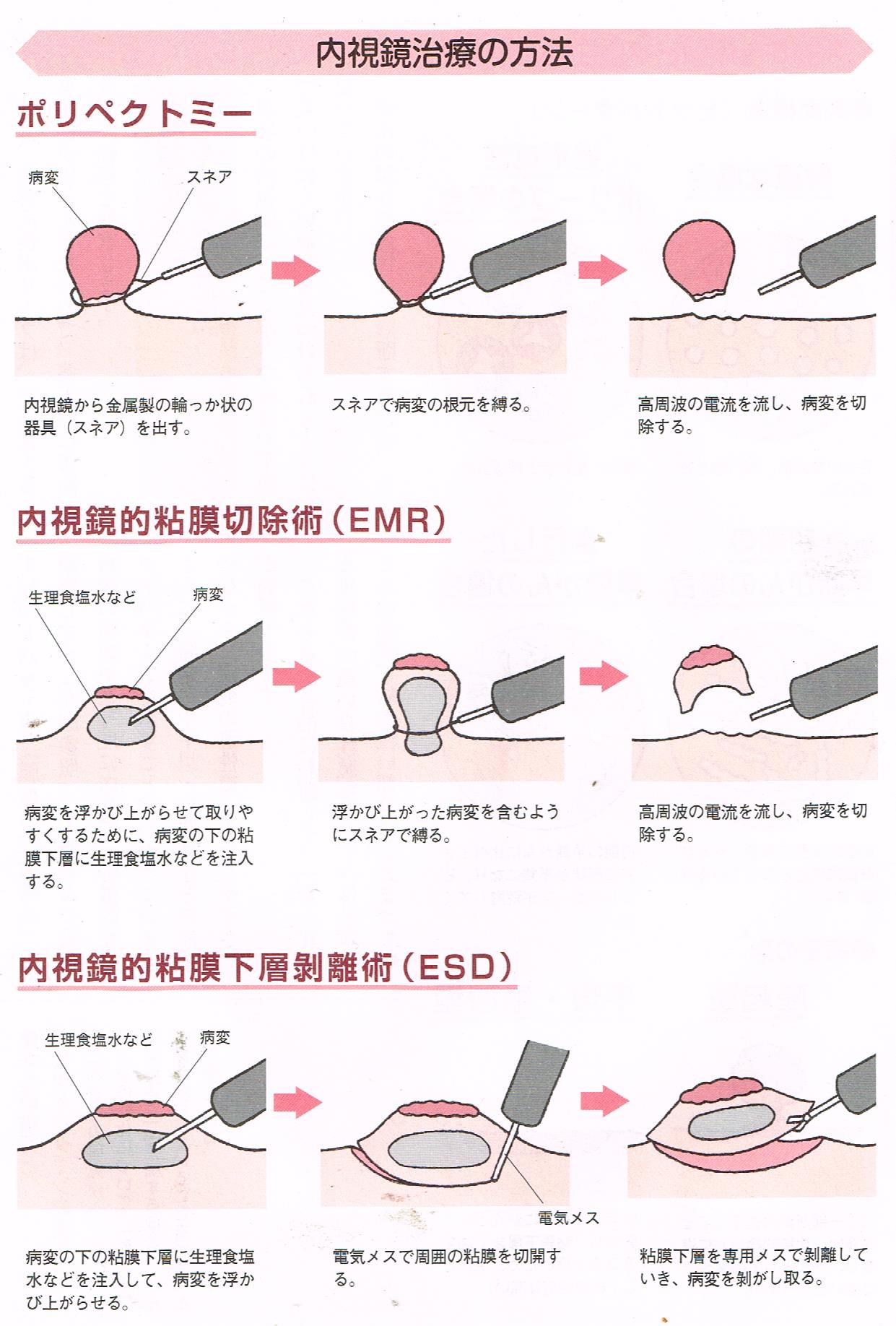 大腸癌の深さや悪性度の指標