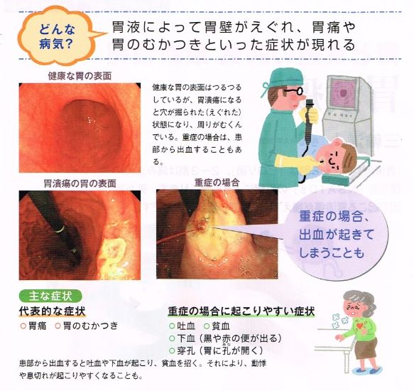 胃潰瘍とは？