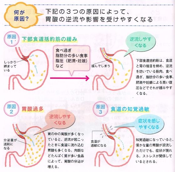 胃食道逆流症の原因