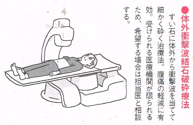 体外衝撃波結石破砕術