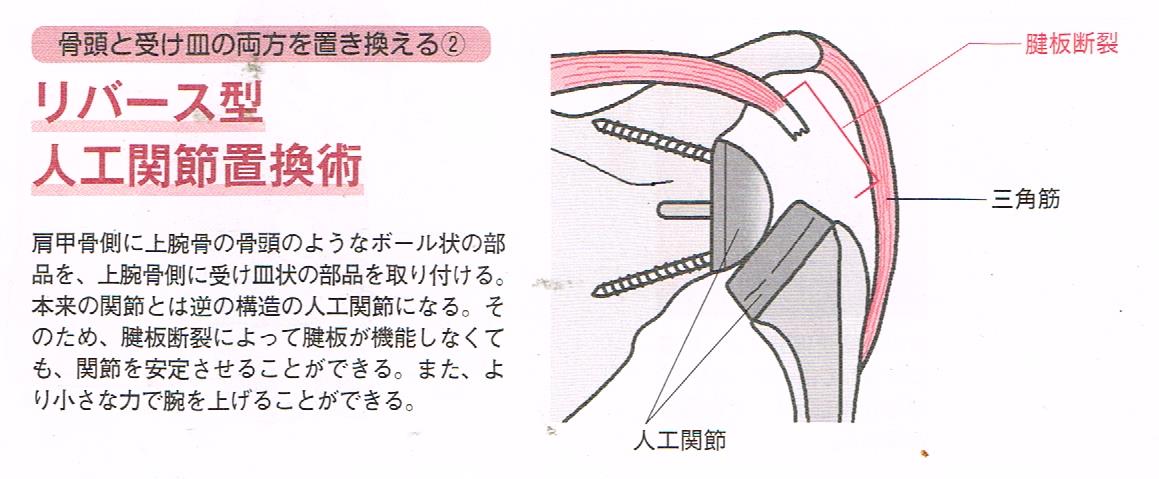 人工関節置換術（従来型）