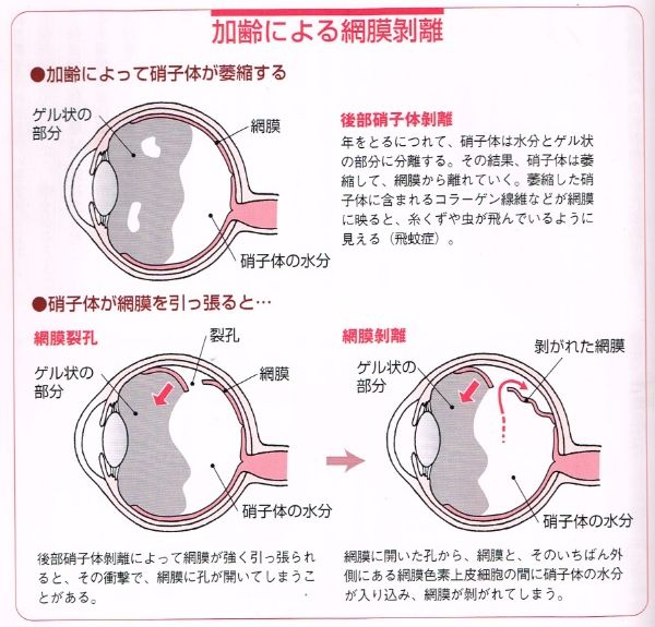 網膜裂孔網膜剥離視野の一部が欠ける