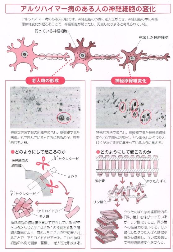 アルツハイマー型認知症のある人の神経細胞の変化